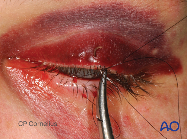 Clinical photograph showing completing the mattress suture during temporary tarsorrhaphy – transcutaneous lower-eyelid approach