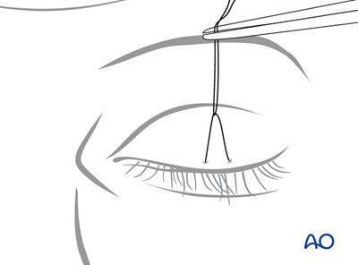 Upper eyelid approach