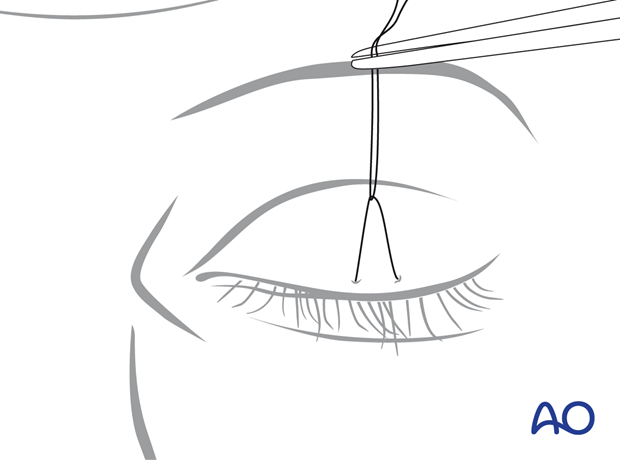 Clinical photograph showing the space is left between the knot and the upper-eyelid skin during temporary tarsorrhaphy – transcutaneous lower-eyelid approach.