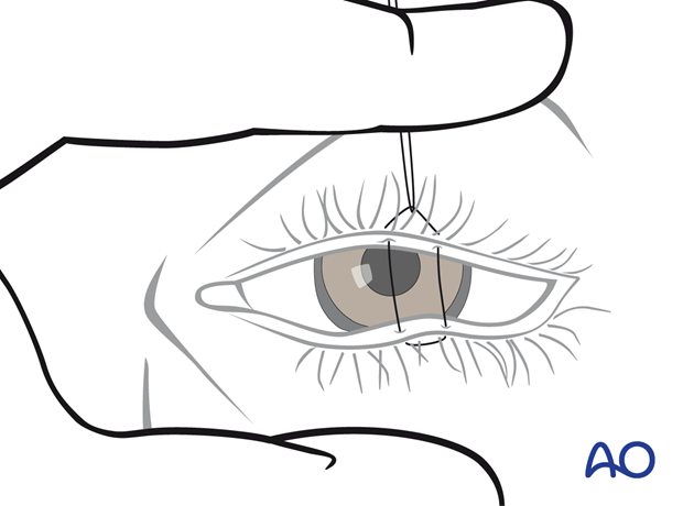 Eyelid may be opened for a forced duction test or evaluation of the pupil – transcutaneous lower-eyelid approach.