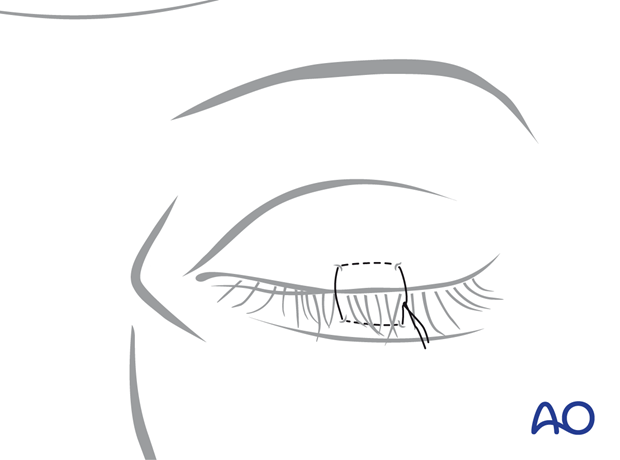 Allternative approach for corneal protection – transcutaneous lower-eyelid approach.