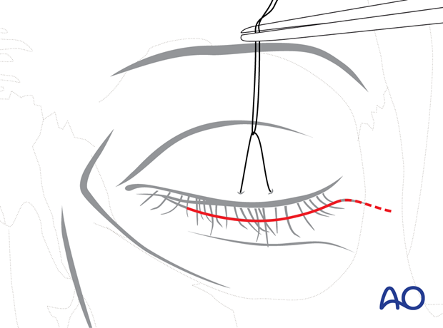 subciliary approach