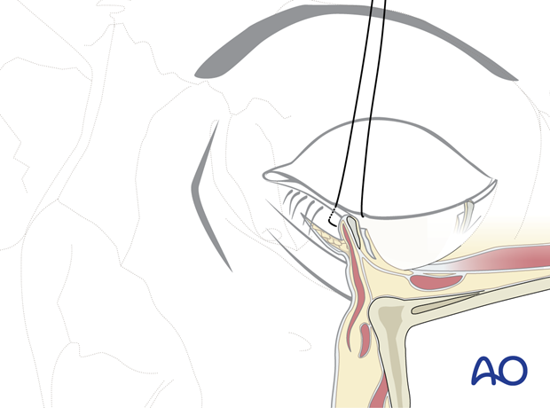 subciliary approach