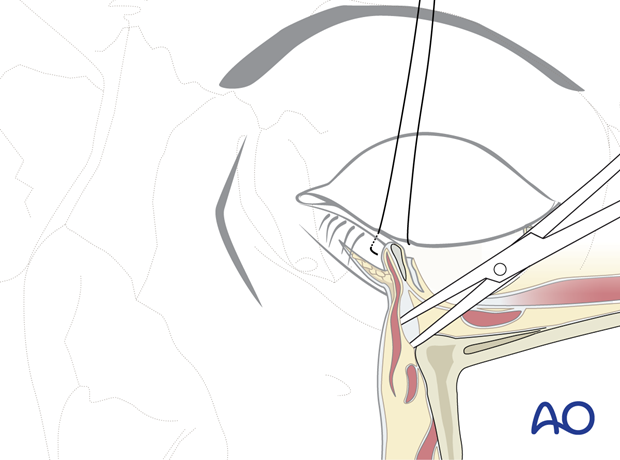 subciliary approach