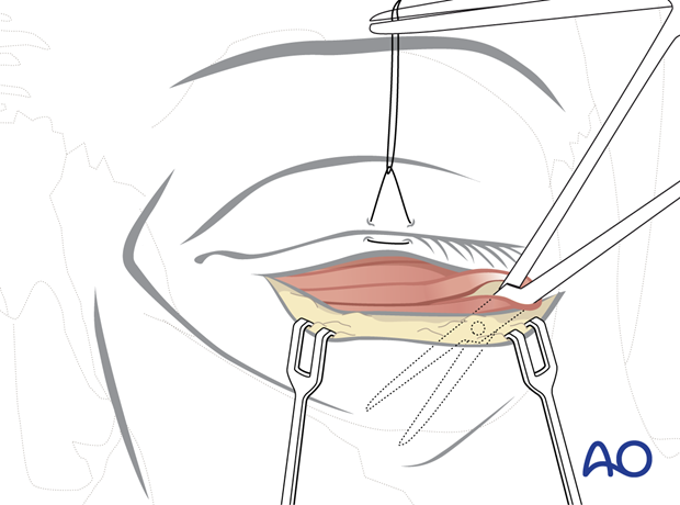 subciliary approach