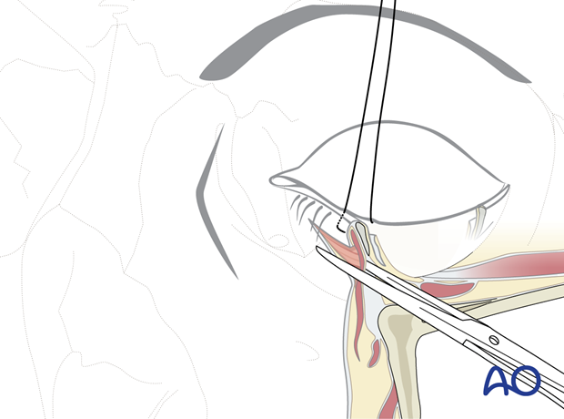 subciliary approach