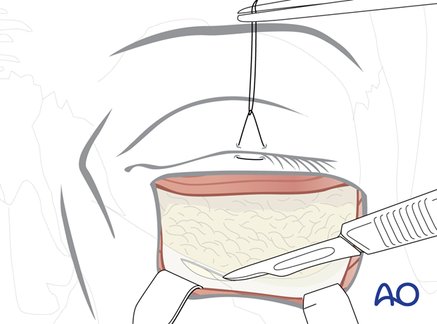 subciliary approach