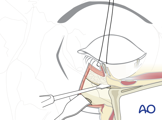 subciliary approach