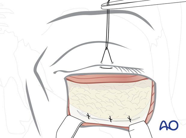 subciliary approach