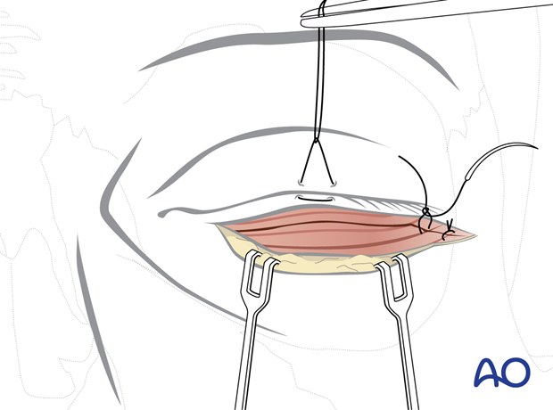 subciliary approach