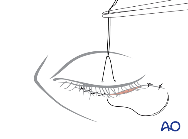 subciliary approach