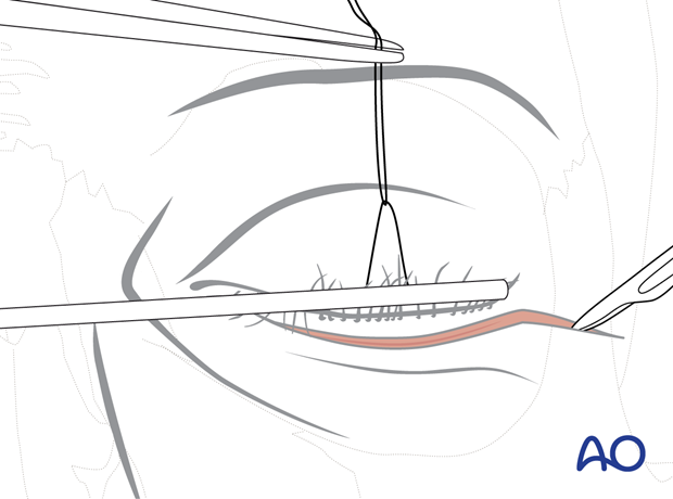 subciliary approach