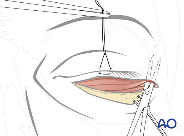 subciliary approach