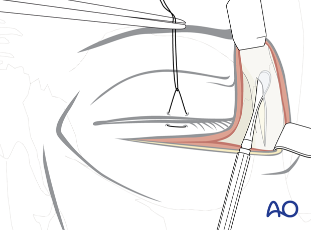 subciliary approach