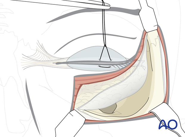 subciliary approach