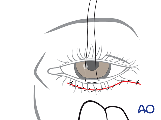 Subtarsal approach