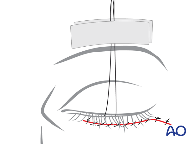 subciliary approach