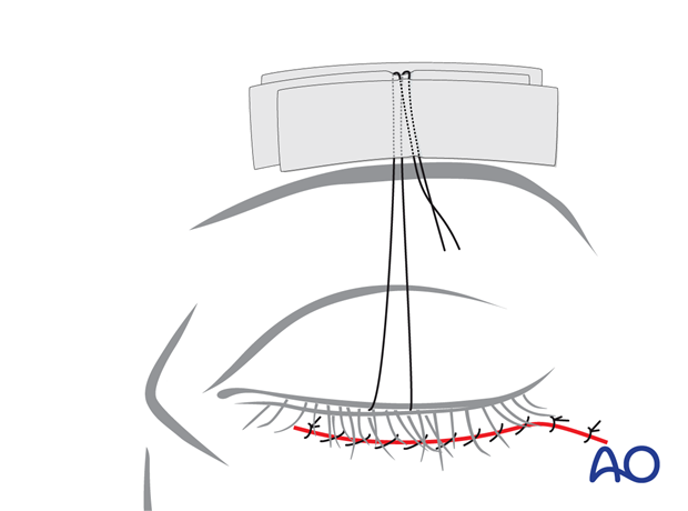 subciliary approach