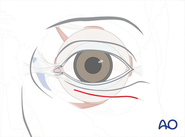 Subtarsal approach