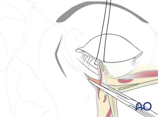 Subtarsal approach