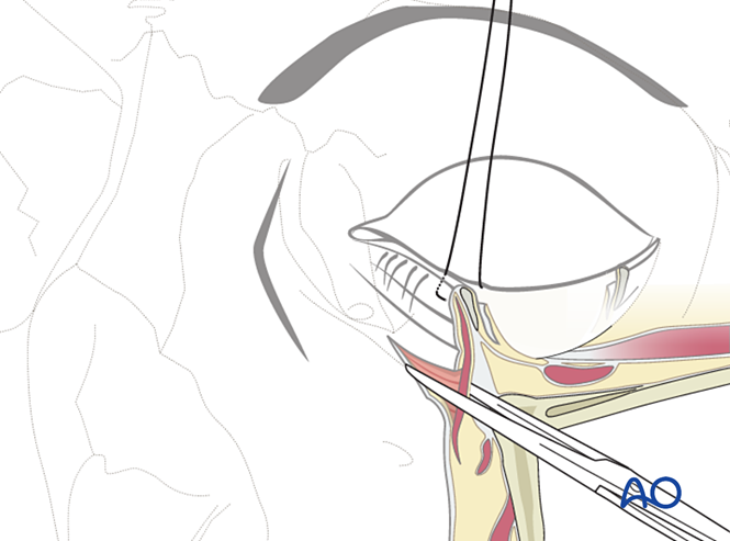 Subtarsal approach