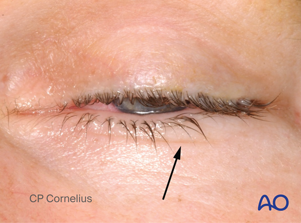 Subtarsal approach