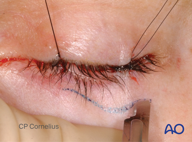 Subtarsal approach