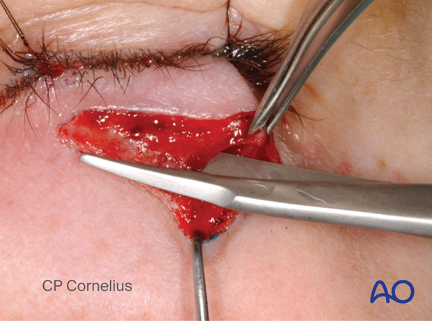 Subtarsal approach