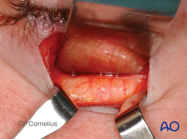 Subtarsal approach