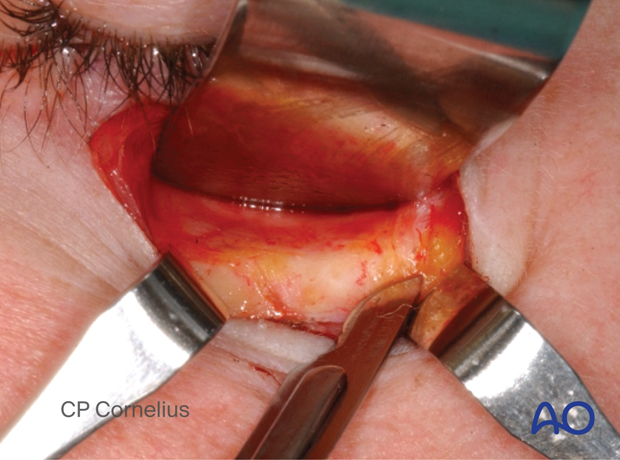 Subtarsal approach