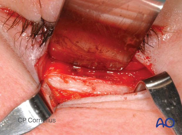 Subtarsal approach