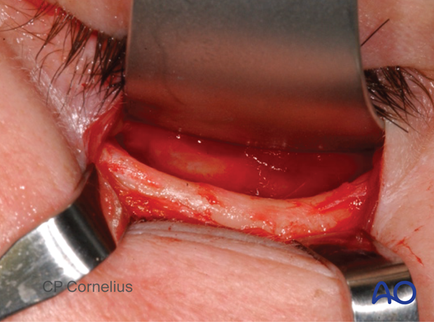 Subtarsal approach