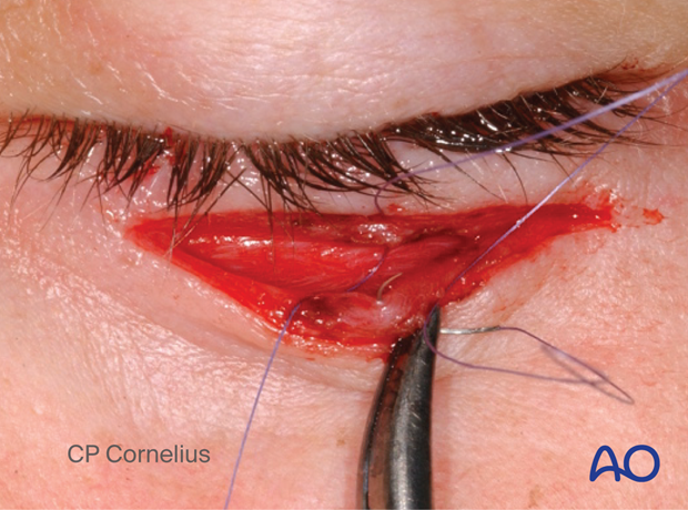 Subtarsal approach