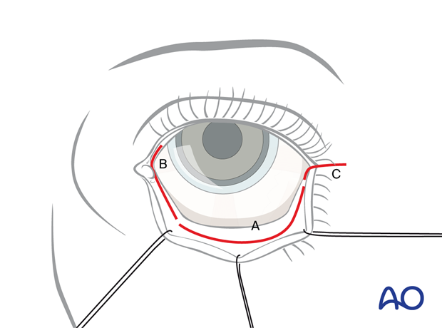 Basic incision lines – transconjunctival lower-eyelid approaches.