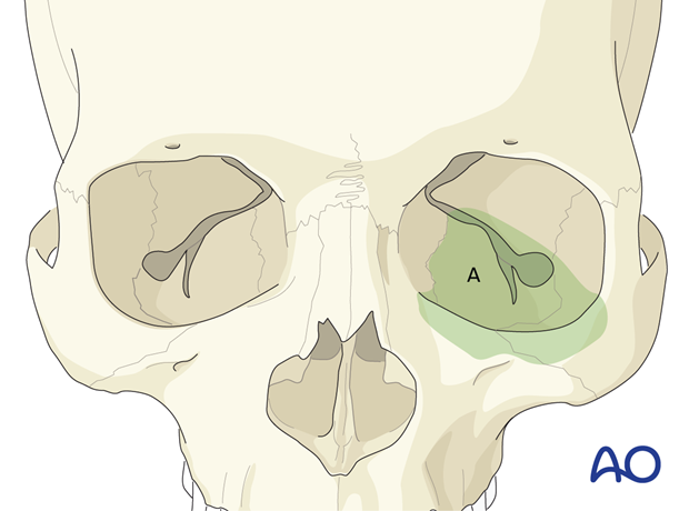 Access areas – transconjunctival lower-eyelid approaches.