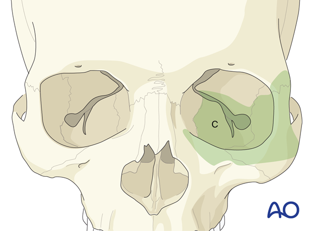 Access area via a lateral canthotomy with the lower fornix transconjunctival lower-eyelid approach.