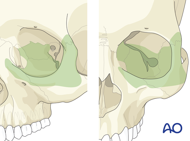 Access area via a C-shaped incision – transconjunctival lower-eyelid approach.