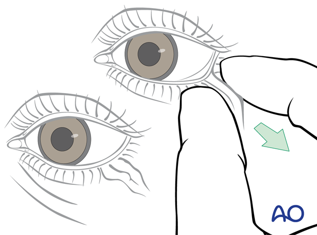 Snap-back test to assess the laxity of the eyelid – transconjunctival lower-eyelid approaches