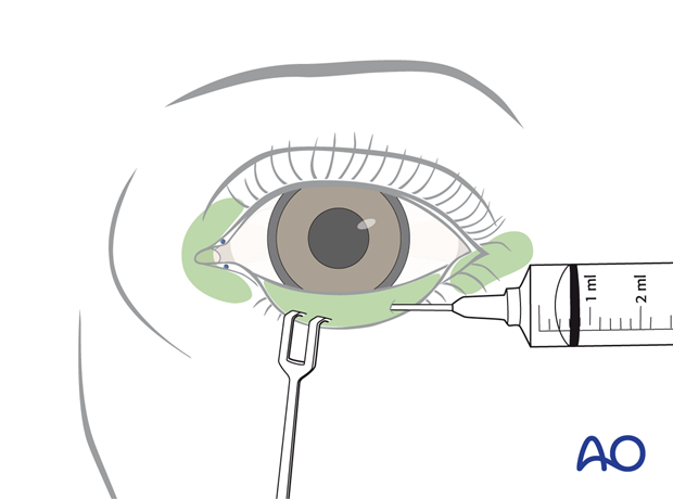 Vasoconstriction – transconjunctival lower-eyelid approaches.