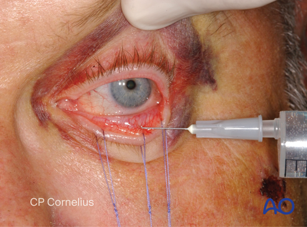 Clinical photograph showing vasoconstriction – transconjunctival lower-eyelid approaches.