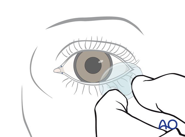 Inserting a corneal shield.