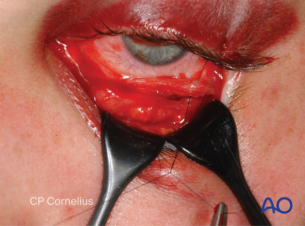 Clinical photograph showing suturing the conjunctival flap to the upper lid margin – transconjunctival lower-eyelid approaches.