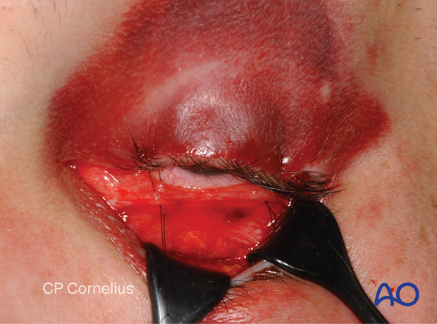 Clinical photograph developing the conjunctival flap – transconjunctival lower-eyelid approaches.