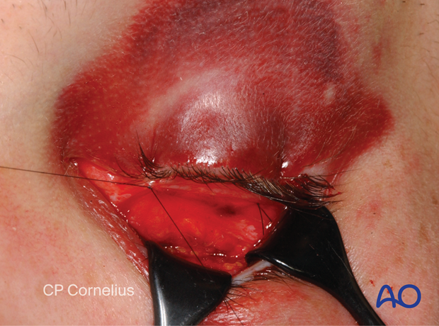 Clinical photograph suturing the conjunctival flap to the upper eyelid – transconjunctival lower-eyelid approaches.