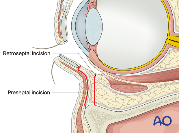 Inferior fornix transconjunctival