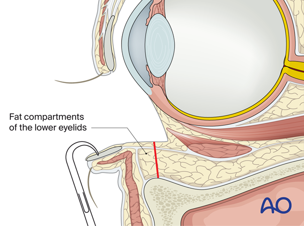 Inferior fornix transconjunctival