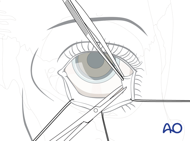 Inferior fornix transconjunctival