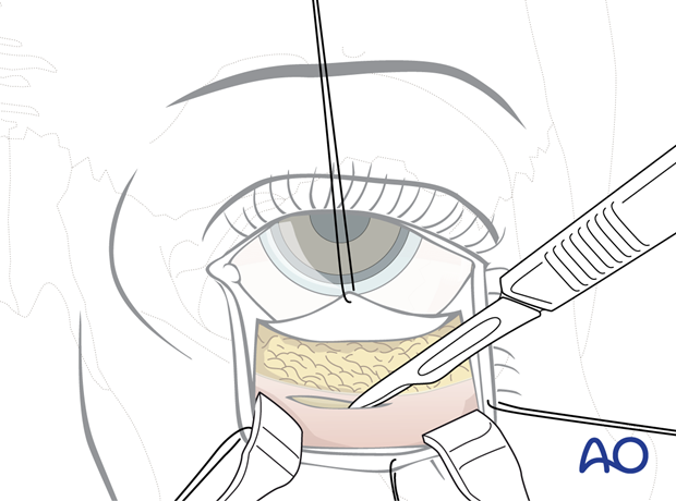 Inferior fornix transconjunctival