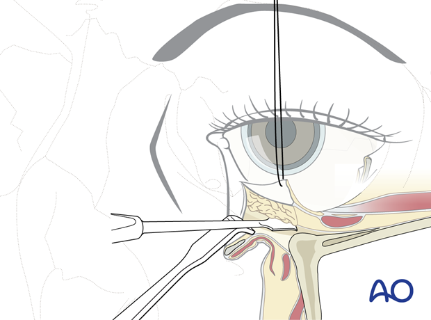 Inferior fornix transconjunctival