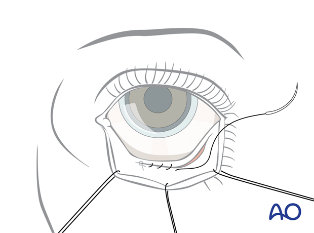 Inferior fornix transconjunctival